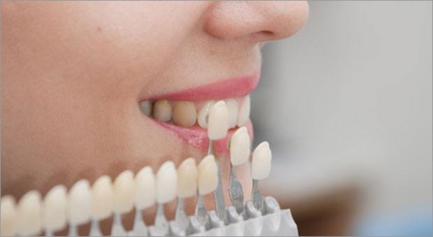Veneers