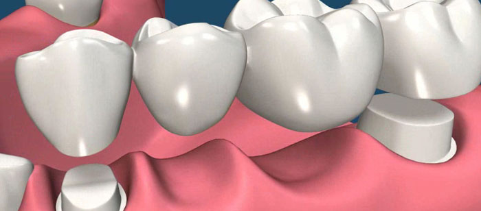 Dental Bridges