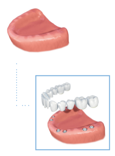 Full Arch Implants